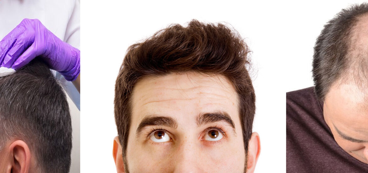 Hair-Loss-Remedies-for-Men