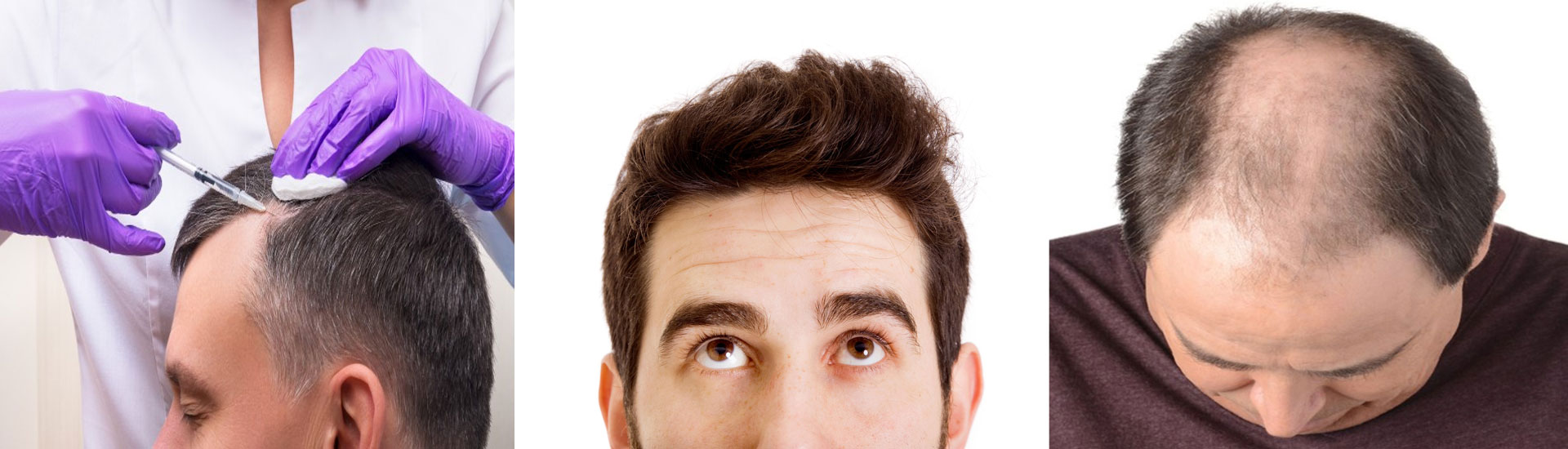 Hair-Loss-Remedies-for-Men